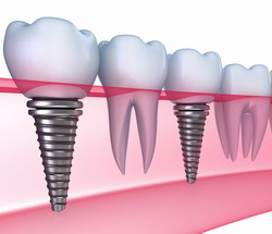 имплантация зубов в центре Ихилов - преимущества