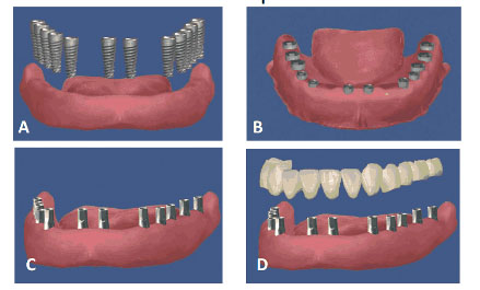 Двухэтапная имплантация зубов с проведением синус-лифтинга