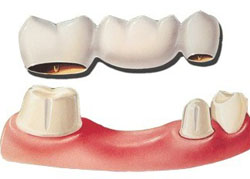 протезирование зубов в МЦ Ихилов