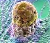 Лечение гипертонии стволовыми клетками