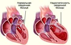 Стволовые клетки сердечная недостаточность
