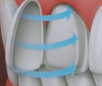 Виниры – эстетические накладки на зубы в МЦ ИХИЛОВ